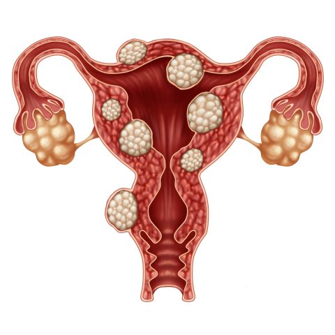 Uterine fibroid medical concept as a human female reproduction uterus disease symbol for fertility problems and reproductive system health.