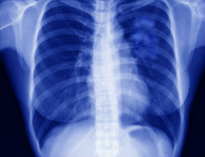 lung cancer awareness