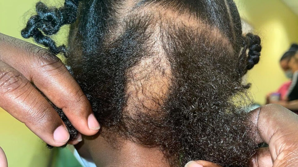 Baileigh scalp Duluth